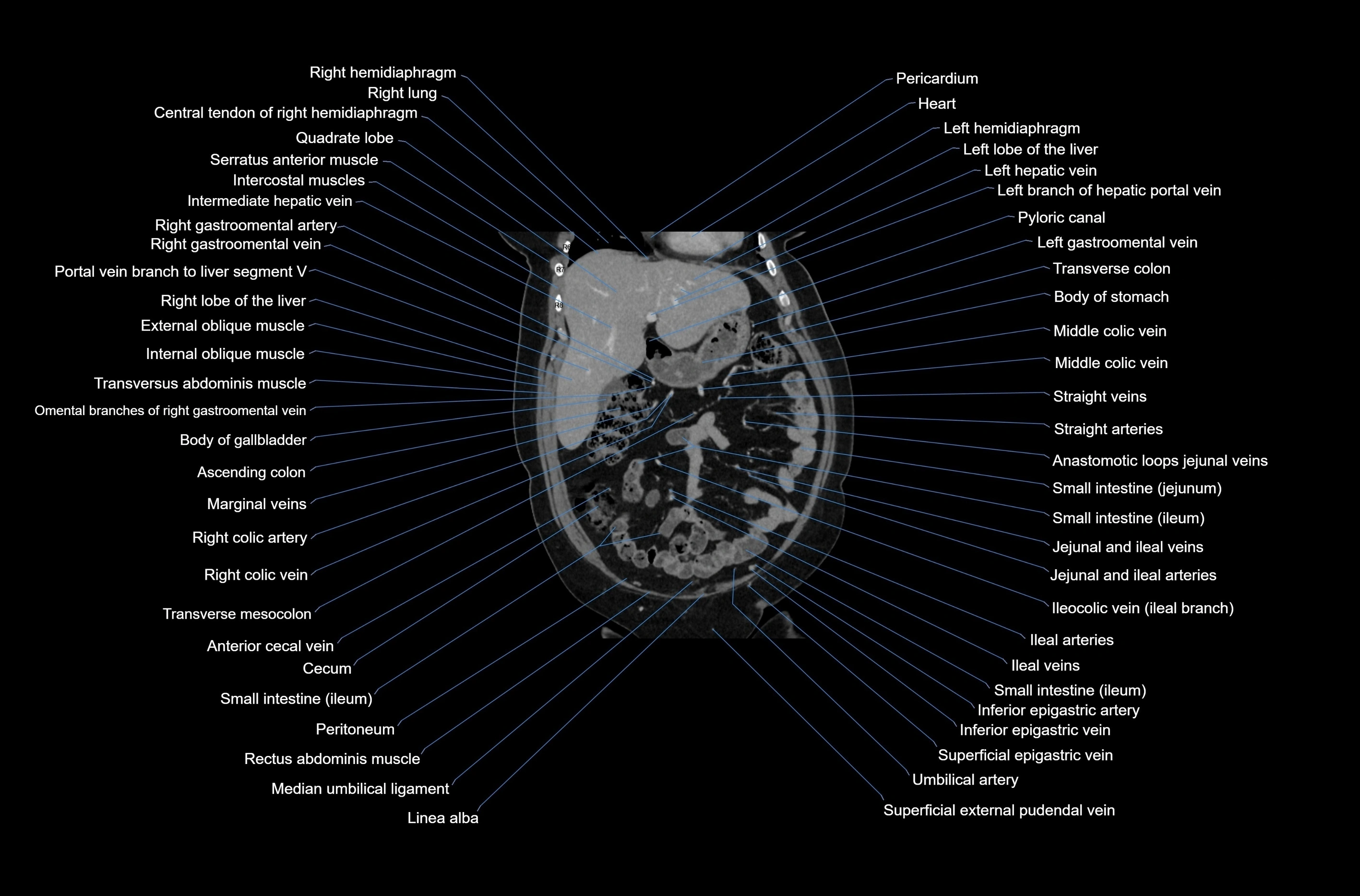 CT abdomen coronal cross sectional anatomy labelled radiology image-00025.webp